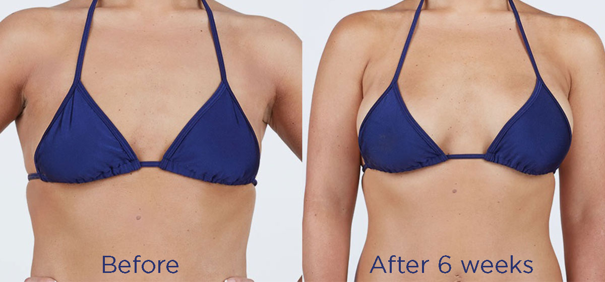 Breast procedure before and after